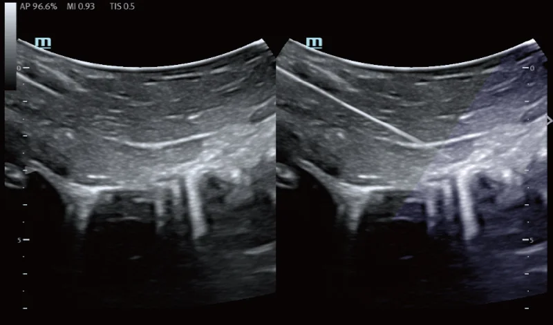 TE5 Vet clinical ultrasound image: INeedle+ on convex