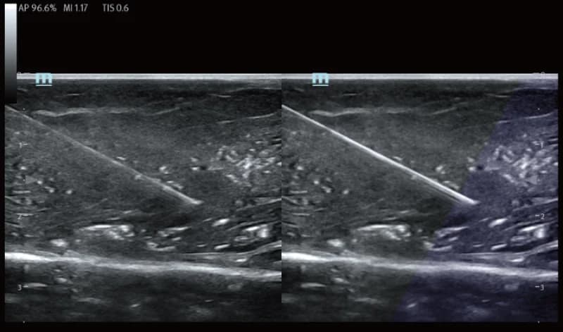 TE5 Vet clinical ultrasound image: INeedle+ on linear