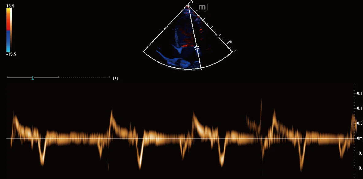 Vetus EQ clinical ultrasound image: Equine Cardiac TVD