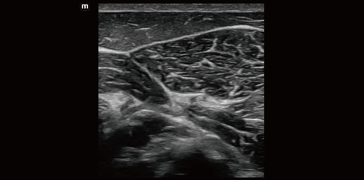 Vetus EQ clinical ultrasound image: Equine Lumbar Muscle
