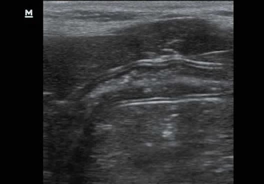 Z60 Vet clinical ultrasound image: Canine Intestine